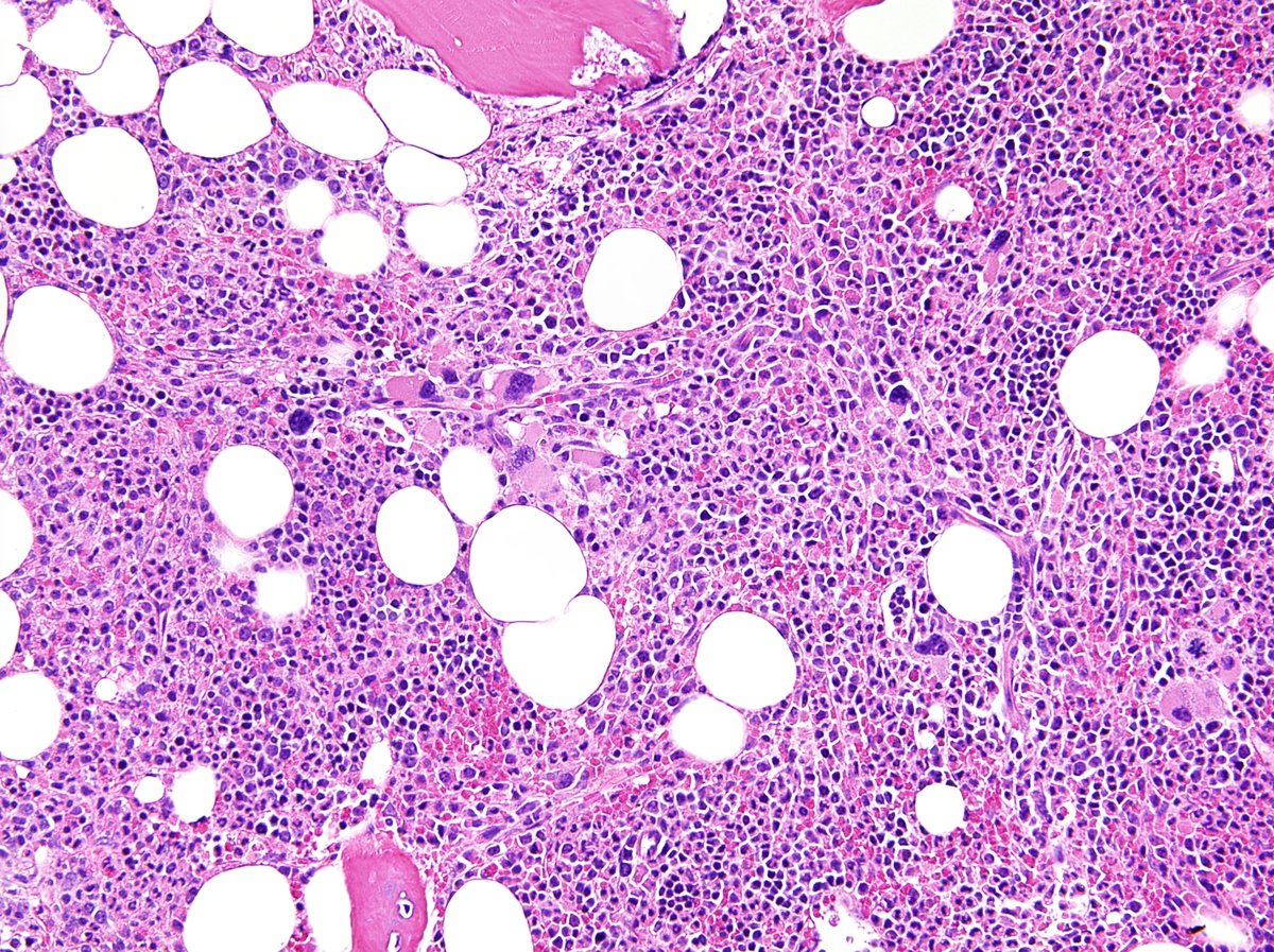Same as first picture. Note the presence of occasional intravascular megakaryopoiesis in dilated marrow vessels. 